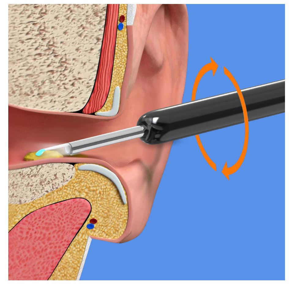 Smart Visual Earwax Removal Kit – 1080P HD Wireless Ear Ottoman Endoscope with LED Light | WiFi Ear Cleaning Camera for iOS & Android | Safe for Kids & Adults – White